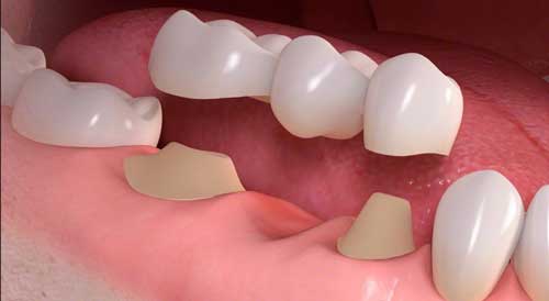 Provo Dentist explains a Dental Bridge