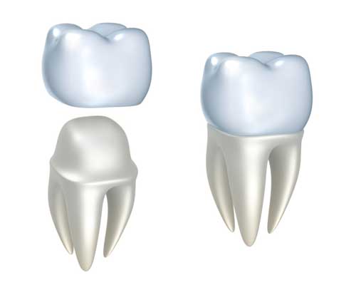 Dental Crowns East Mountain Dental dentist in Provo ut