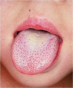 A white substances grows on this patient's tongue