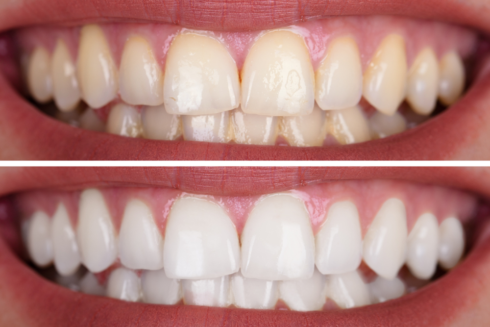 The Teeth Whitening Process