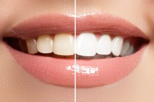 Teeth Whitening Provo